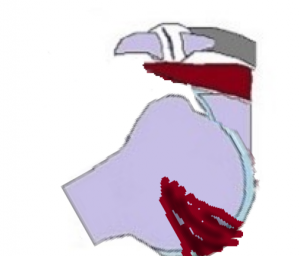 dislocation